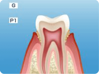 軽度歯周炎