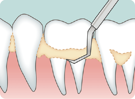 ルートプレーニング